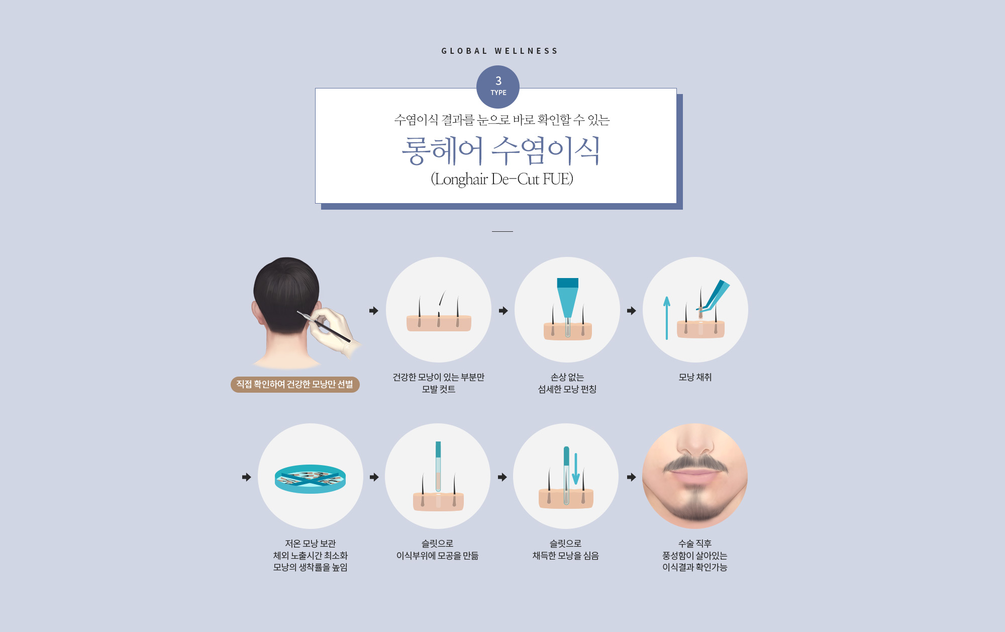 롱헤어 수염이식 롱헤어 디컷퓨 수술 직후 풍성함이 살아있는 결과