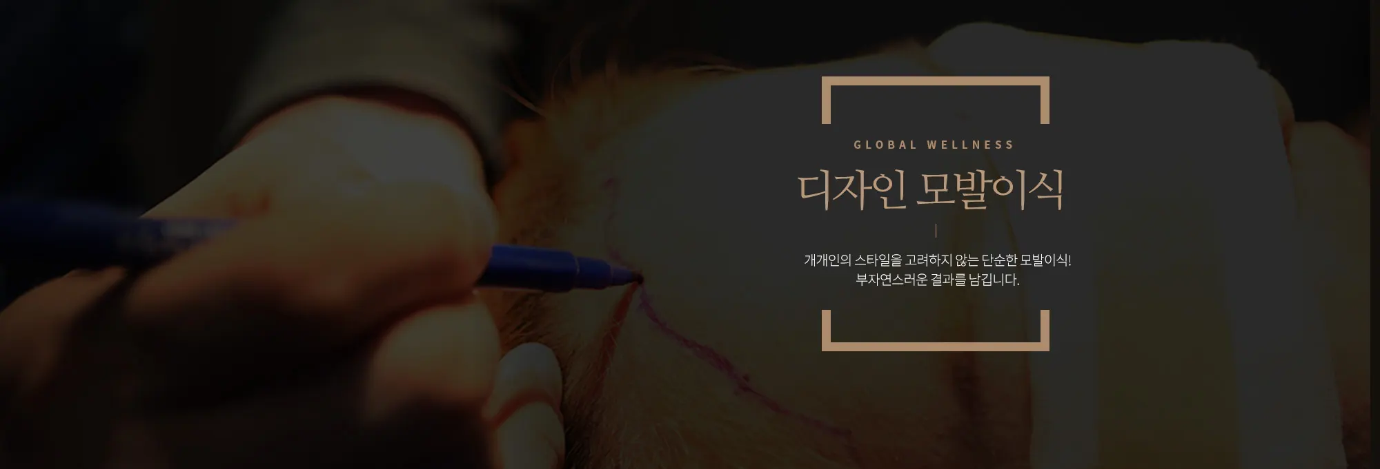 모발이식 시스템