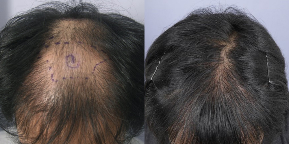 Before-After 비교