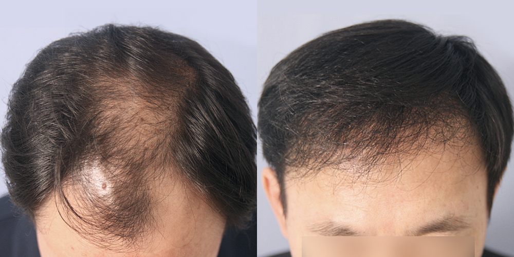 Before-After 비교 2