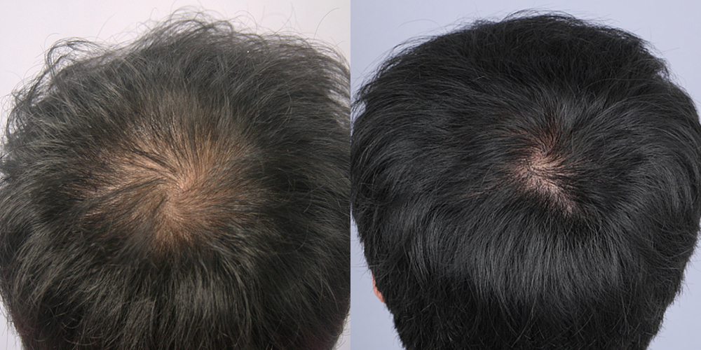 Before-After 비교 2