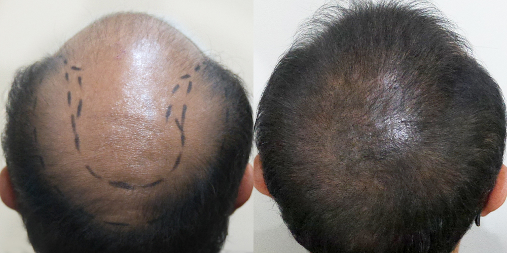 Before-After 비교 2