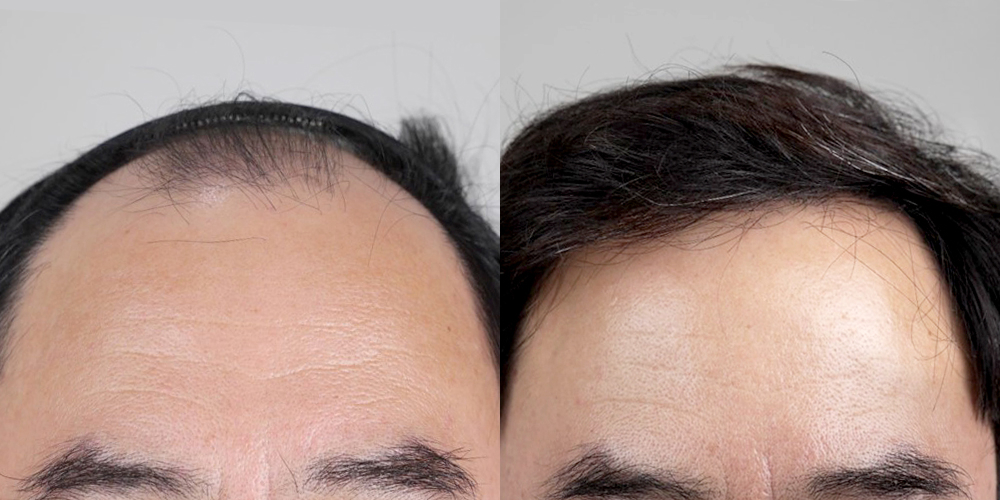 Before-After 비교 2