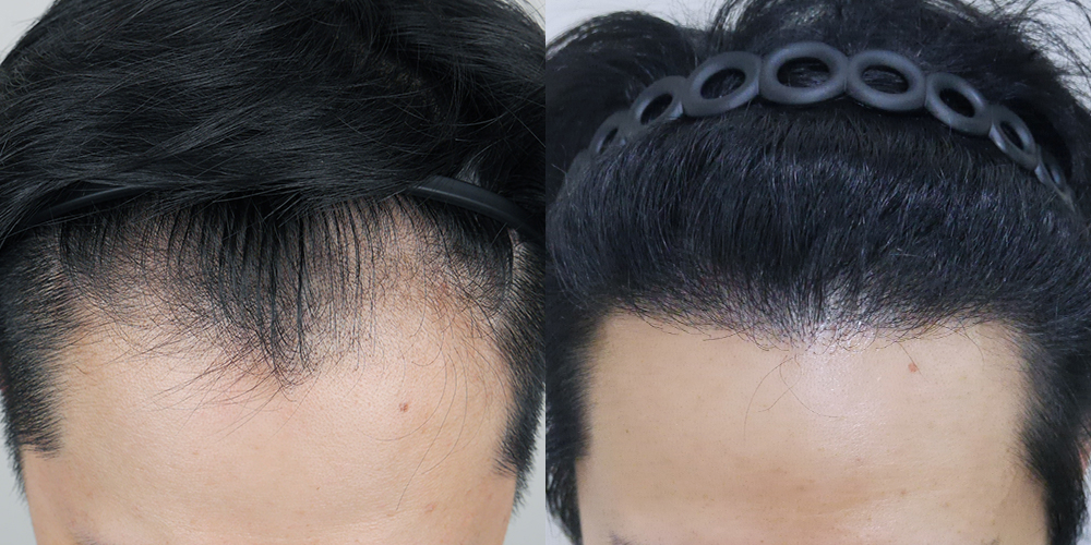 Before-After 비교 2