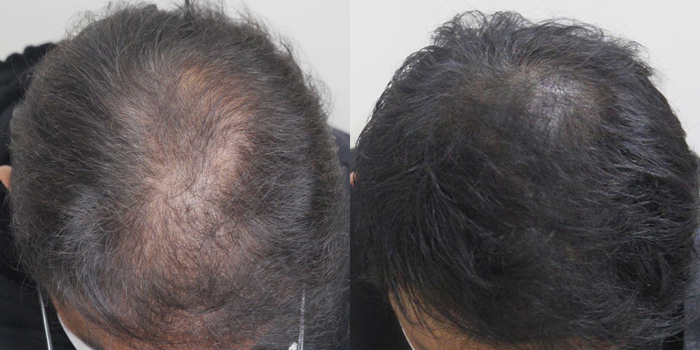 Before-After 비교