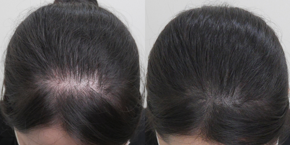 Before-After 비교 2