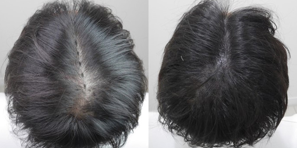 Before-After 비교 2