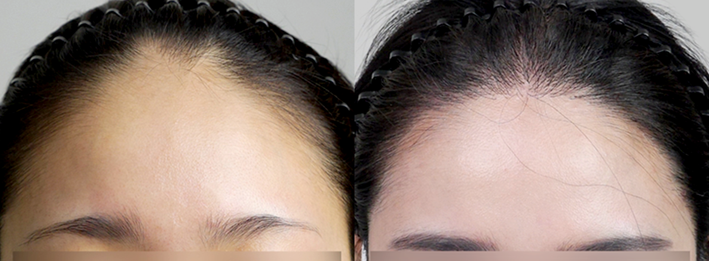 Before-After 비교