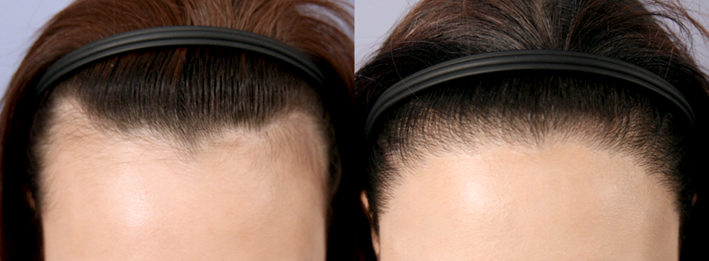 Before-After 비교 2
