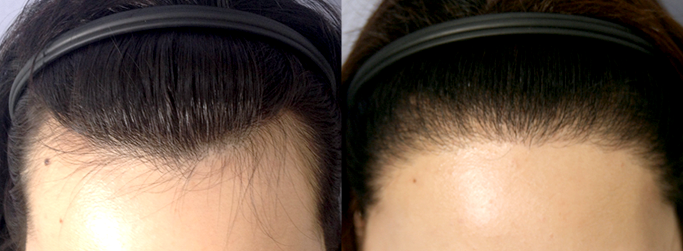 Before-After 비교 2
