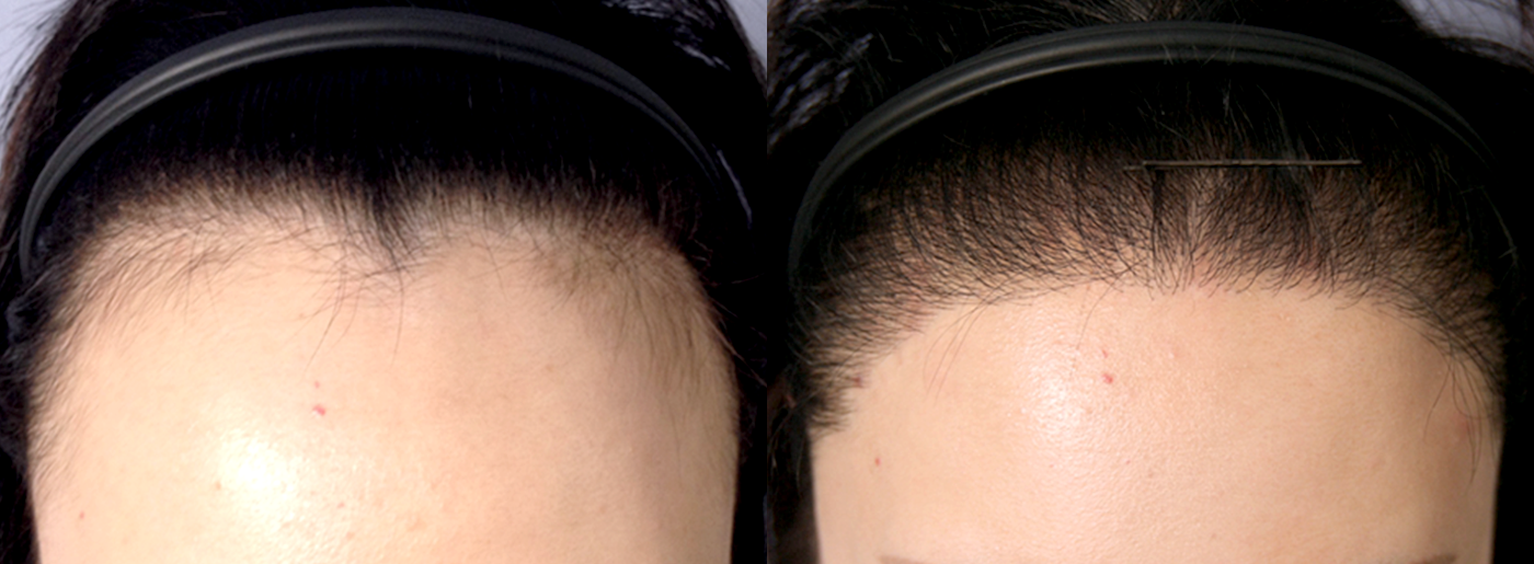 Before-After 비교 2